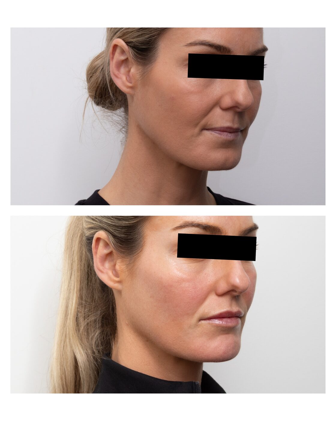 Facial balancing — lip, cheek and chin before and after, Skin By Olivia Wānaka