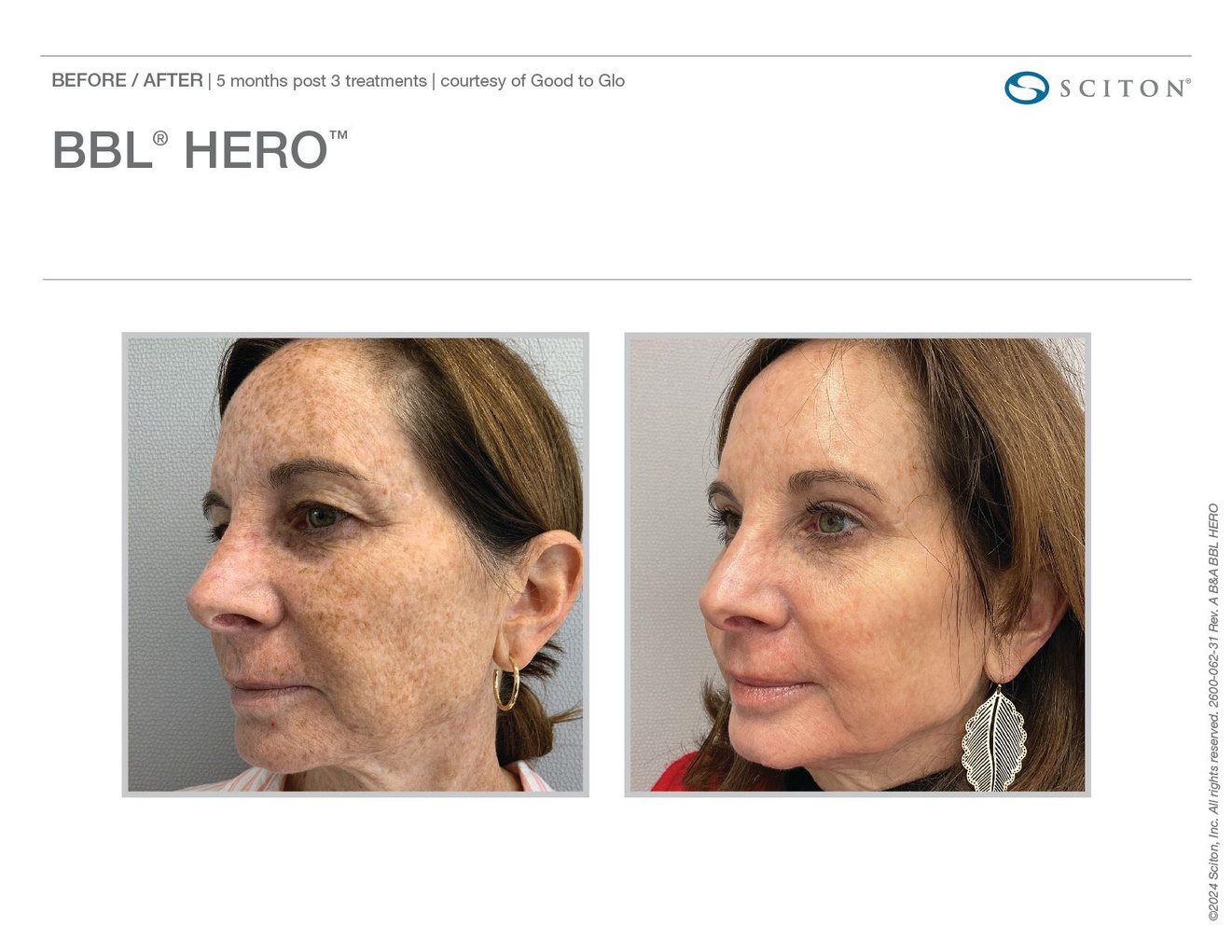BBL® HERO™ before and after, Sciton clinical image