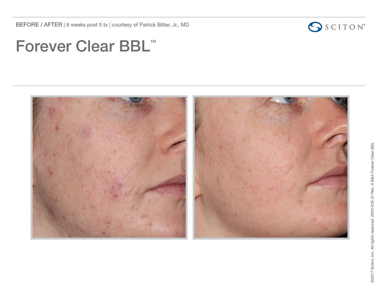 Forever Clear BBL® before and after, Sciton clinical image