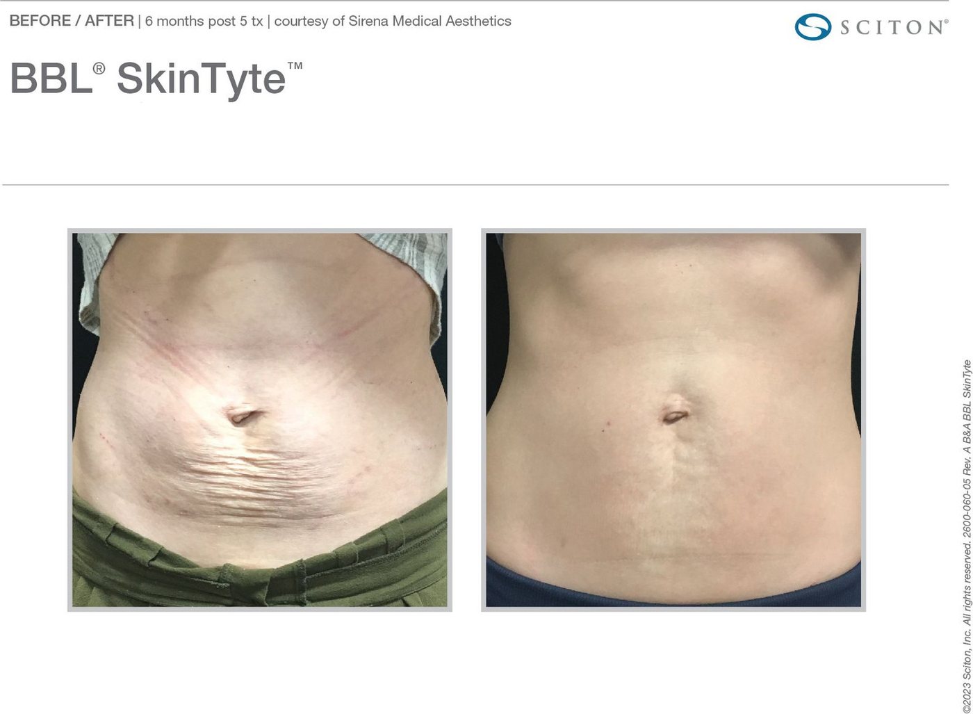 SkinTyte™ before and after, Sciton clinical image